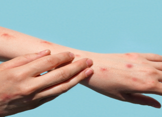 Serviço Social da Construção elabora medidas preventivas contra Varíola de Macacos